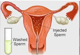 Intrauterine Insemination - IUI