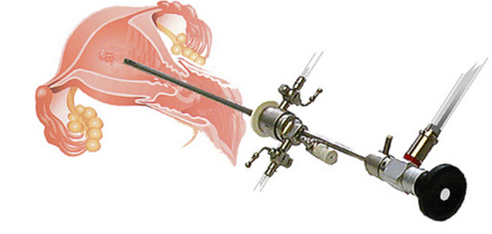 Hysteroscopy Procedure