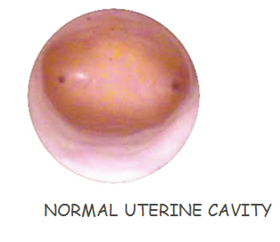 Normal Uterine Cavity