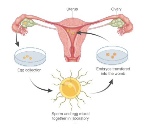 In vitro fertilization (IVF)