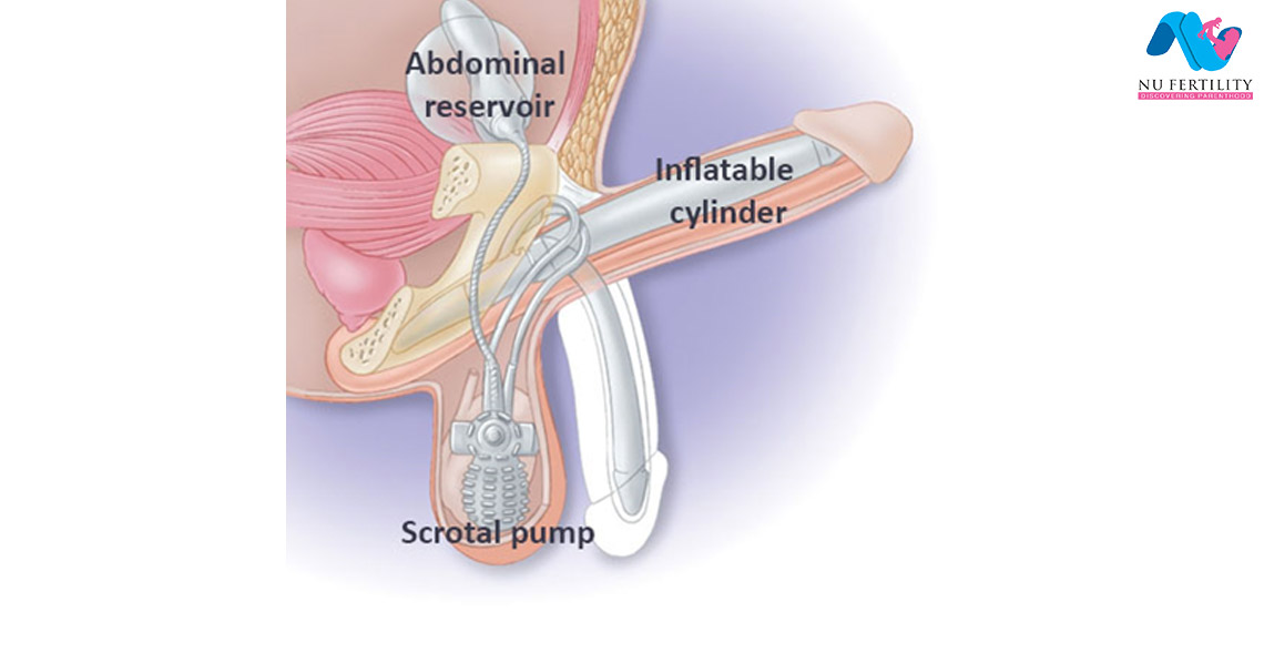 Inflatable penile implant