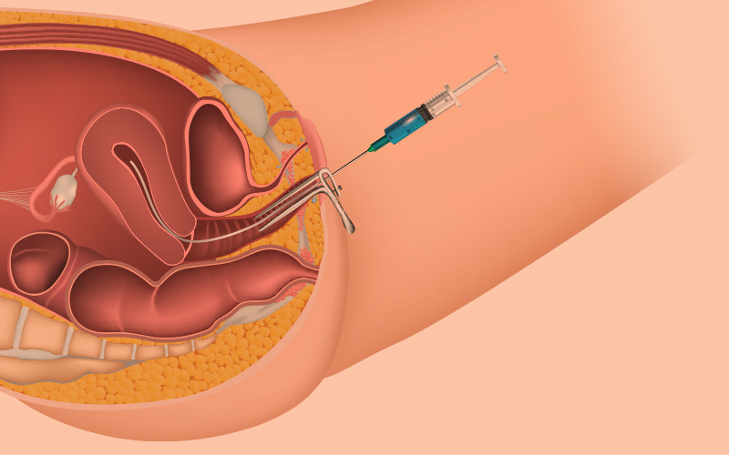 Intrauterine Insemination Process - NU fertility