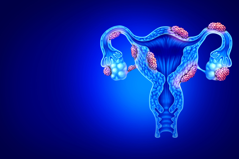  Anatomy of Endometriosis Disease in Female Infertility - NU Fertility