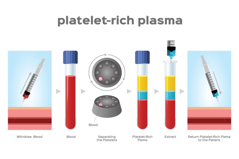 Platelet Rich Plasma - NU Fertility