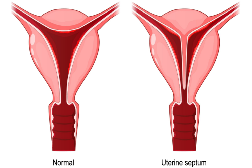 Uterine Septum Comparison - NU Fertility