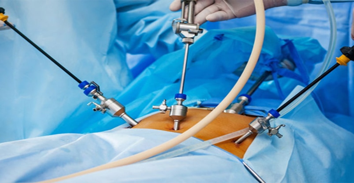 Laparoscopy Surgery for Infertility & Blocked Fallopian Tubes