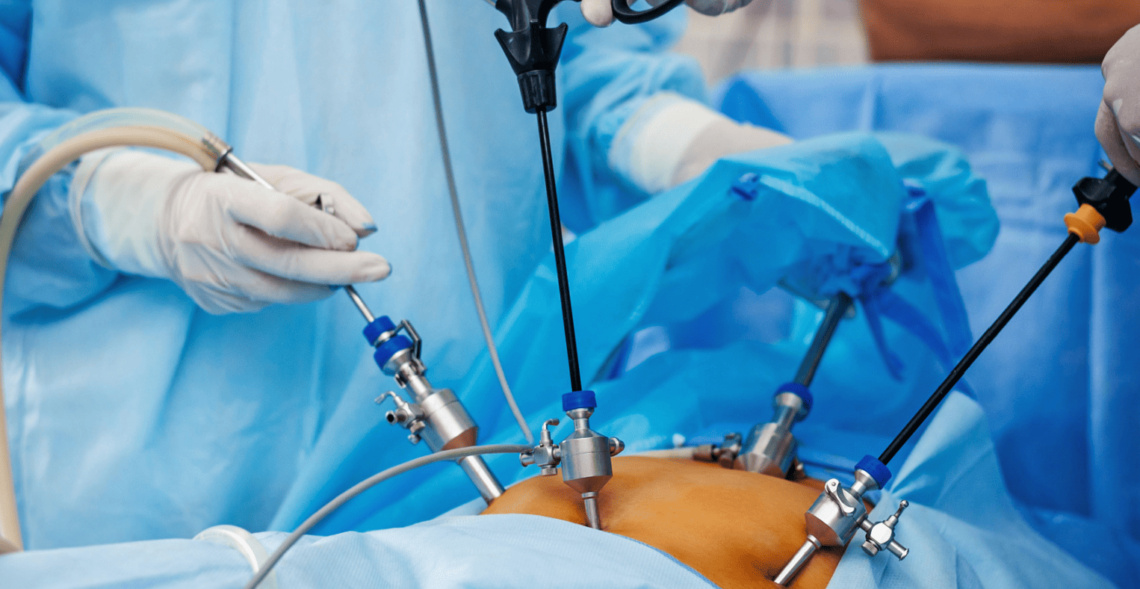 Laparoscopy for Infertility – Procedure and Recovery Time